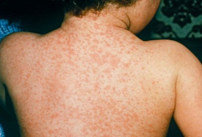 measles-1-701x476